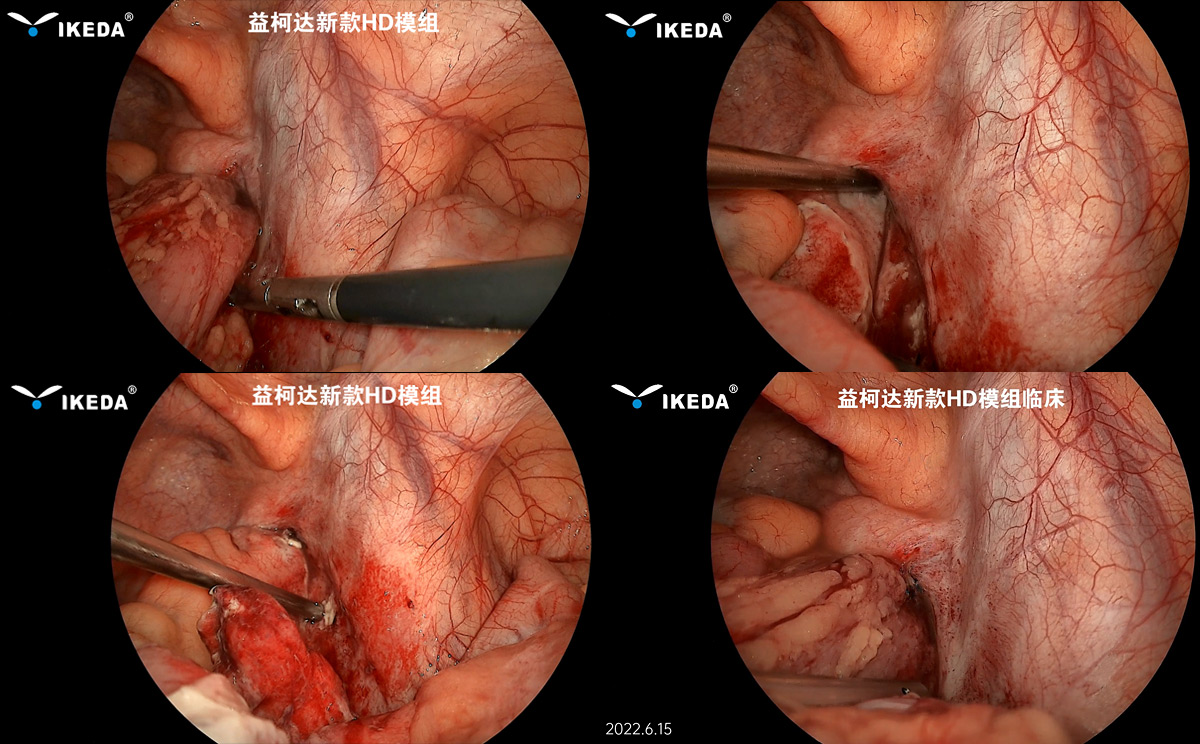 益柯達-新款HD內(nèi)窺鏡模組首次臨床